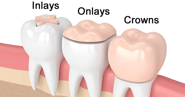 Inlays and Onlays